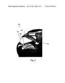 PROSTHETIC DEVICES AND METHODS FOR USING SAME diagram and image