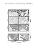 Methods and Compositions Involving NKG2D Inhibitors and Cancer diagram and image