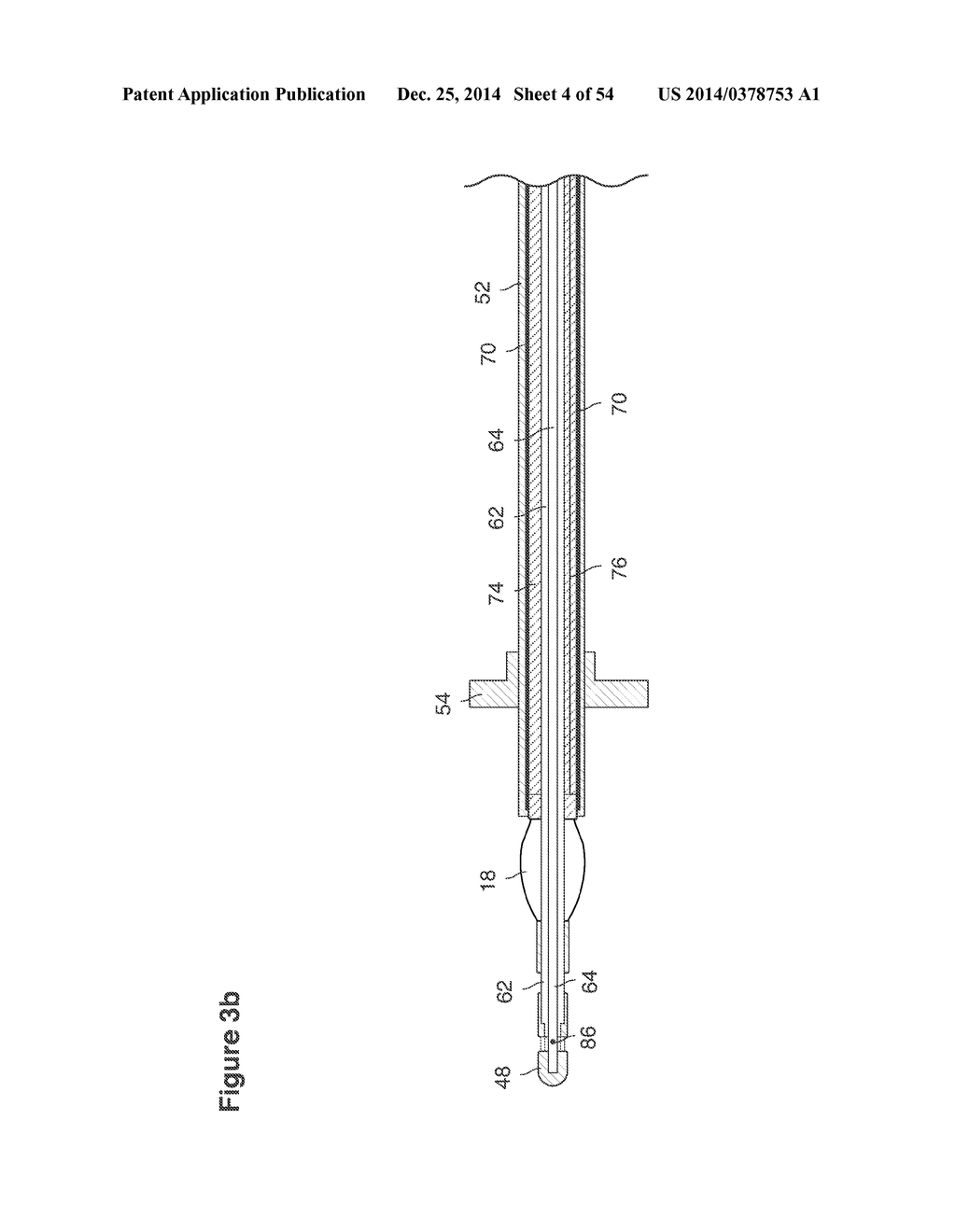 UTERINE LAVAGE FOR EMBRYO RETRIEVAL - diagram, schematic, and image 05