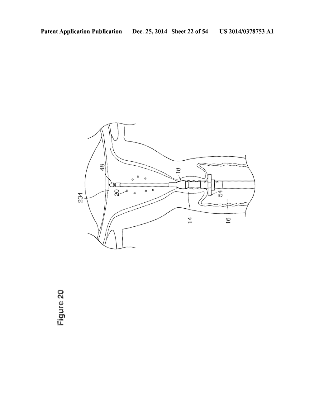 UTERINE LAVAGE FOR EMBRYO RETRIEVAL - diagram, schematic, and image 23