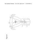 UTERINE LAVAGE FOR EMBRYO RETRIEVAL diagram and image