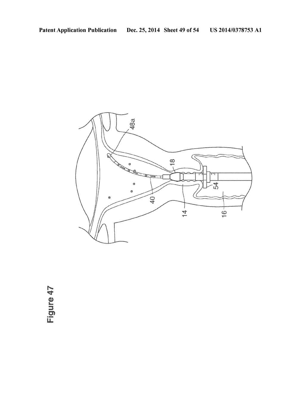 UTERINE LAVAGE FOR EMBRYO RETRIEVAL - diagram, schematic, and image 50