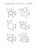 INTESTINAL DEVICES AND METHODS FOR FACILITATING WEIGHT LOSS diagram and image