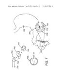 INTESTINAL DEVICES AND METHODS FOR FACILITATING WEIGHT LOSS diagram and image