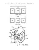 INTESTINAL DEVICES AND METHODS FOR FACILITATING WEIGHT LOSS diagram and image