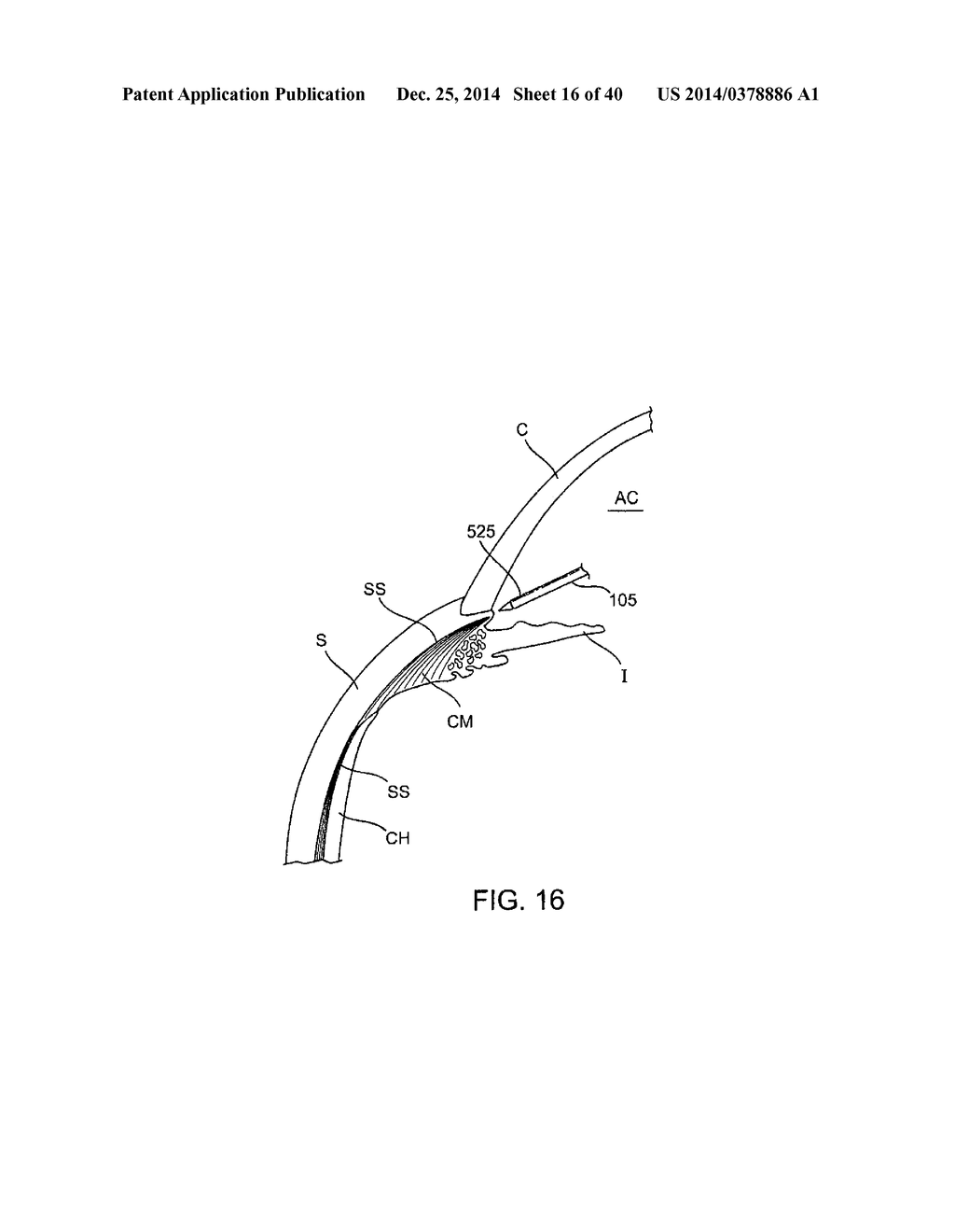 Glaucoma Treatment Device - diagram, schematic, and image 17