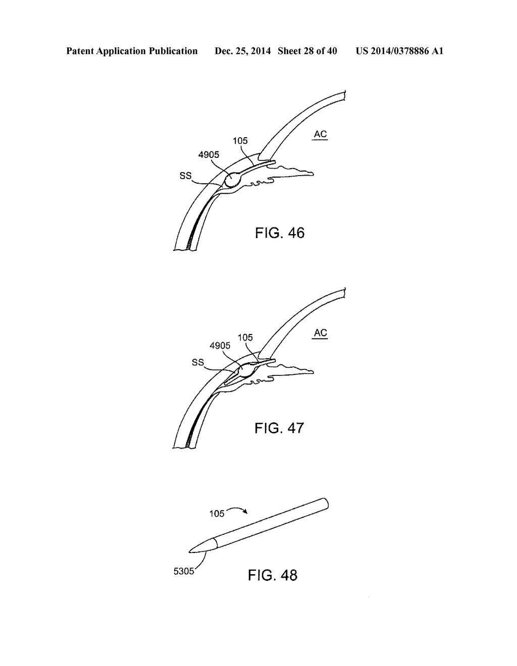 Glaucoma Treatment Device - diagram, schematic, and image 29