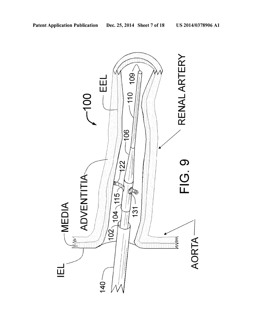 PERI-VASCULAR TISSUE ABLATION CATHETER WITH MECHANICAL SUPPORT STRUCTURES - diagram, schematic, and image 08