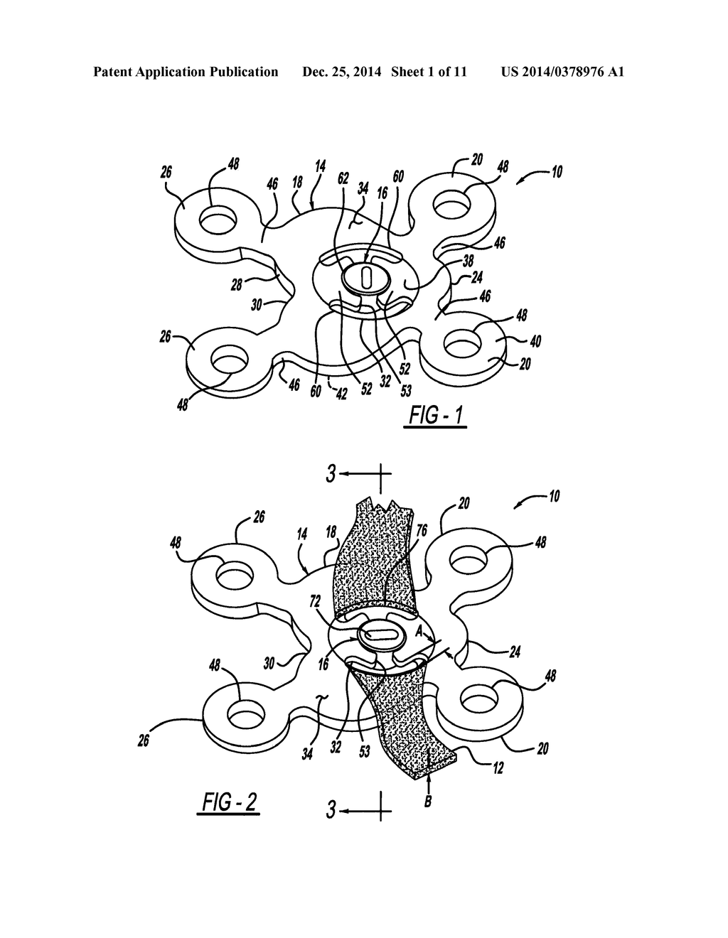 LOCKING MECHANISM TO SECURE ENDS OF AN IMPLANTABLE FABRIC - diagram, schematic, and image 02