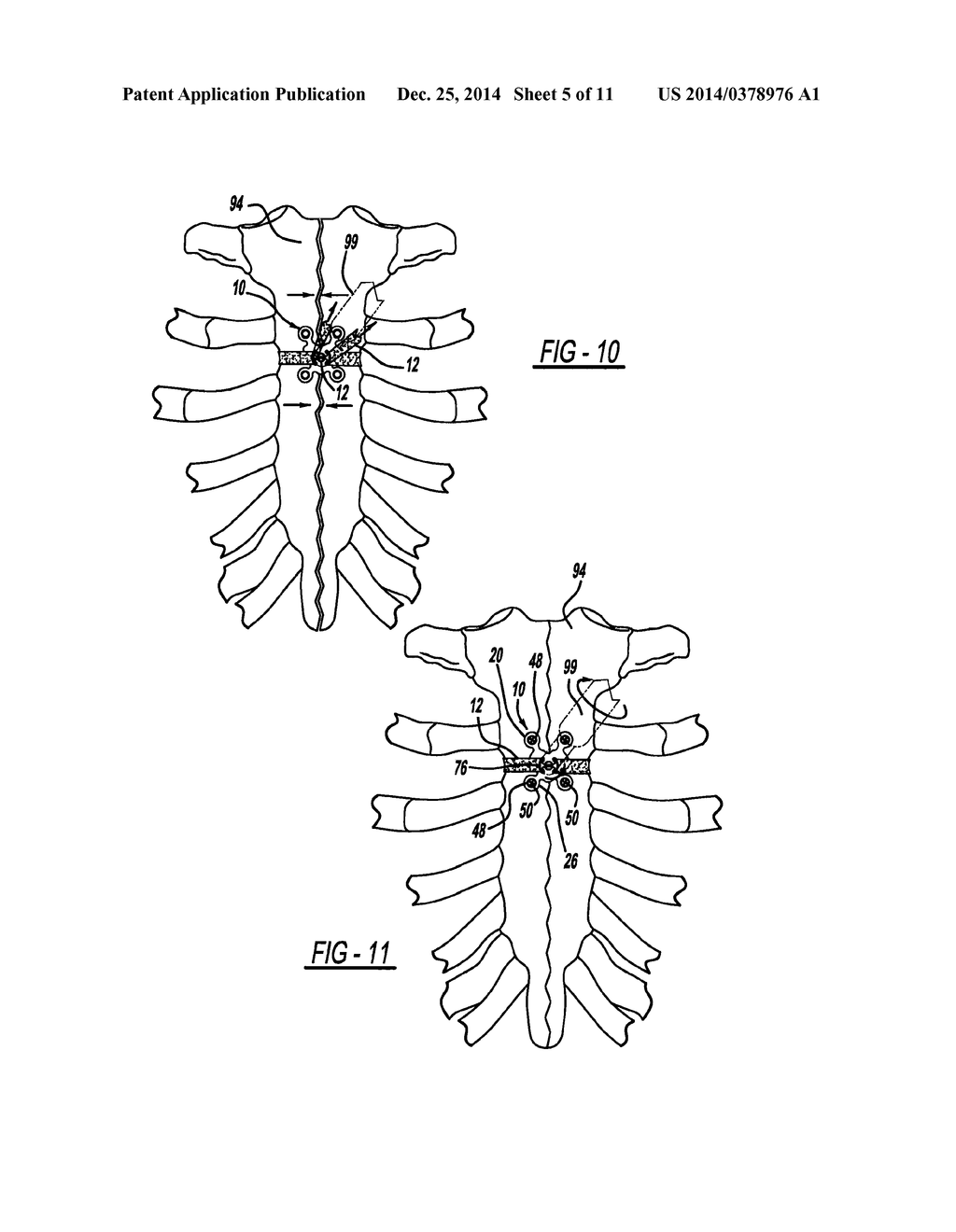 LOCKING MECHANISM TO SECURE ENDS OF AN IMPLANTABLE FABRIC - diagram, schematic, and image 06