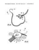 LOCKING MECHANISM TO SECURE ENDS OF AN IMPLANTABLE FABRIC diagram and image