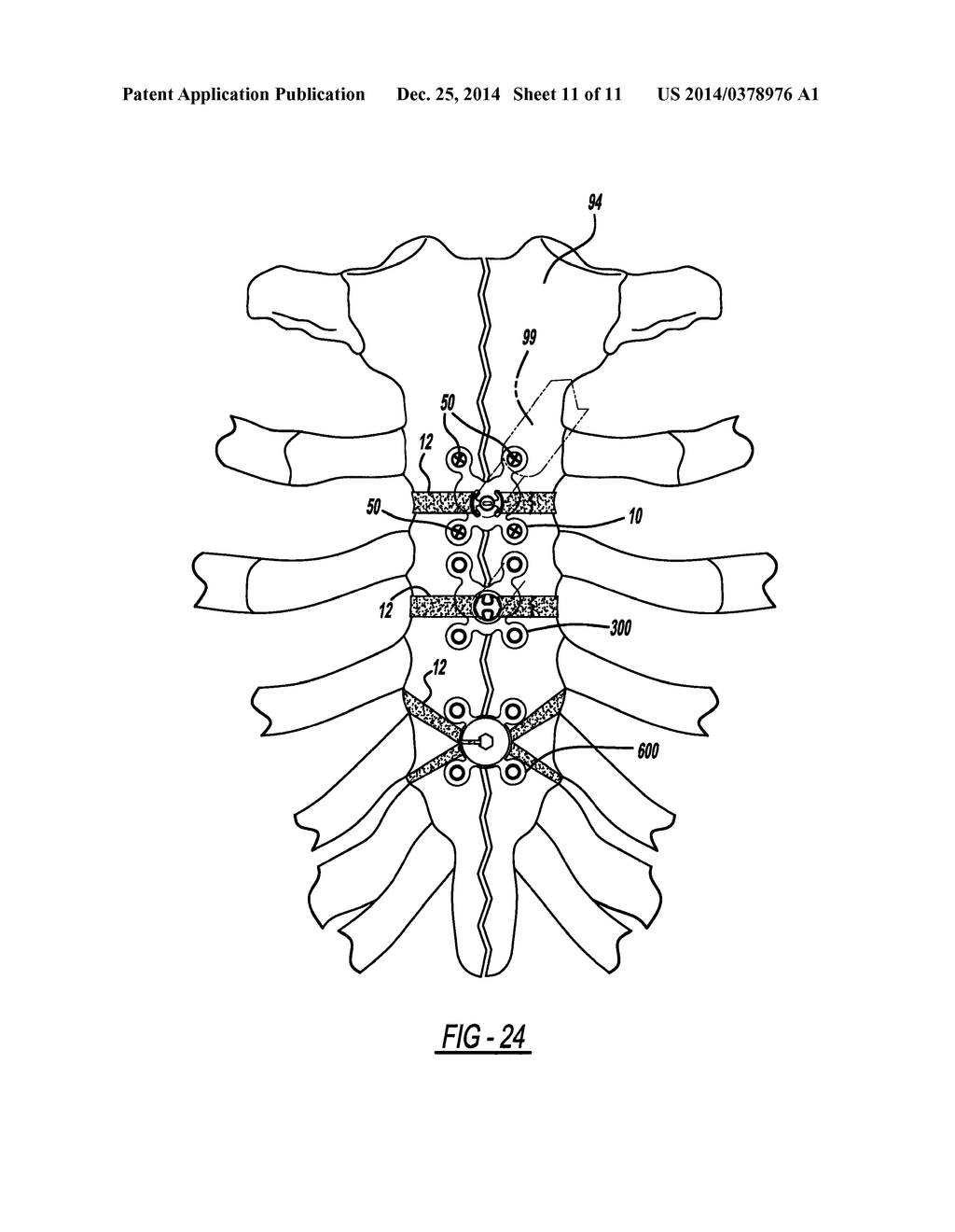 LOCKING MECHANISM TO SECURE ENDS OF AN IMPLANTABLE FABRIC - diagram, schematic, and image 12