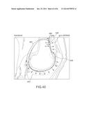 ARTHROPLASTY JIGS WITH MATING ACCURACY diagram and image