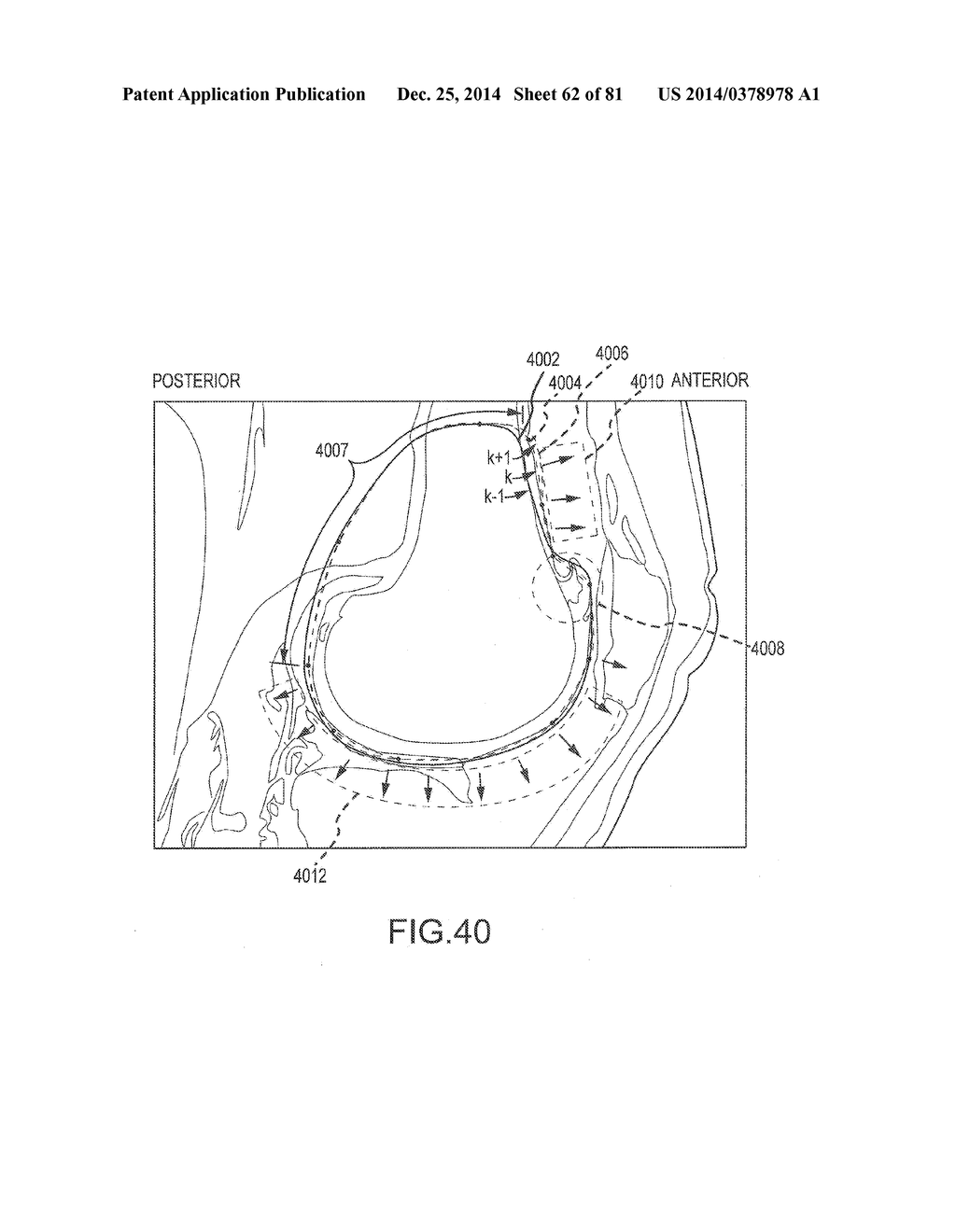 ARTHROPLASTY JIGS WITH MATING ACCURACY - diagram, schematic, and image 63