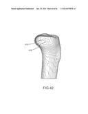 ARTHROPLASTY JIGS WITH MATING ACCURACY diagram and image