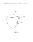 ARTHROPLASTY JIGS WITH MATING ACCURACY diagram and image