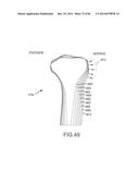 ARTHROPLASTY JIGS WITH MATING ACCURACY diagram and image