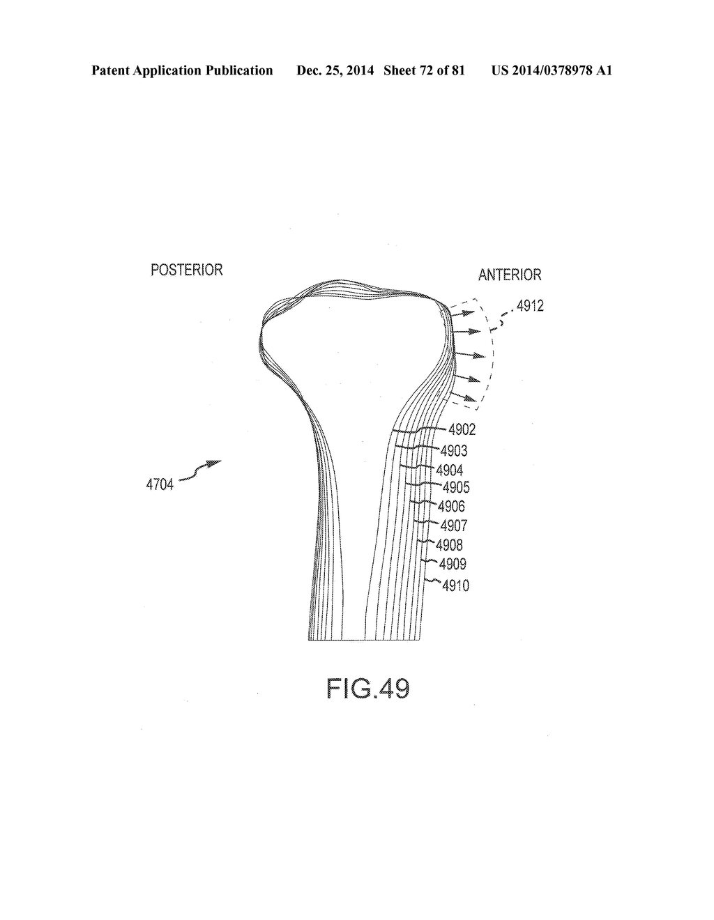 ARTHROPLASTY JIGS WITH MATING ACCURACY - diagram, schematic, and image 73