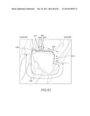 ARTHROPLASTY JIGS WITH MATING ACCURACY diagram and image