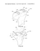 ARTHROPLASTY JIGS WITH MATING ACCURACY diagram and image