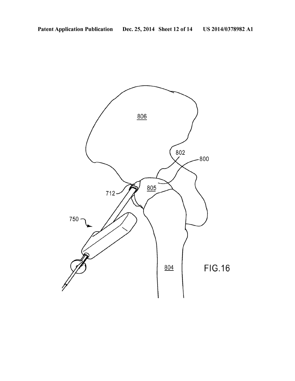 DEVICE AND METHOD FOR HIP DISTENTION AND ACCESS - diagram, schematic, and image 13