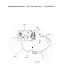 SURGICAL TRAJECTORY ALIGNMENT DEVICE diagram and image