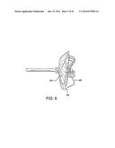 LEFT ATRIAL APPENDAGE OCCLUSIVE DEVICES diagram and image