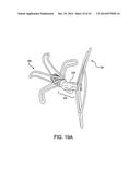 LEFT ATRIAL APPENDAGE OCCLUSIVE DEVICES diagram and image