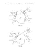 IMPLANT DEVICE WITH STABLIZER diagram and image