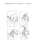 SUTURING CONSTRUCT WITH SPLICED TAILS diagram and image