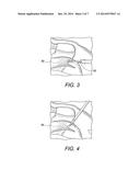 SUTURING CONSTRUCT WITH SPLICED TAILS diagram and image