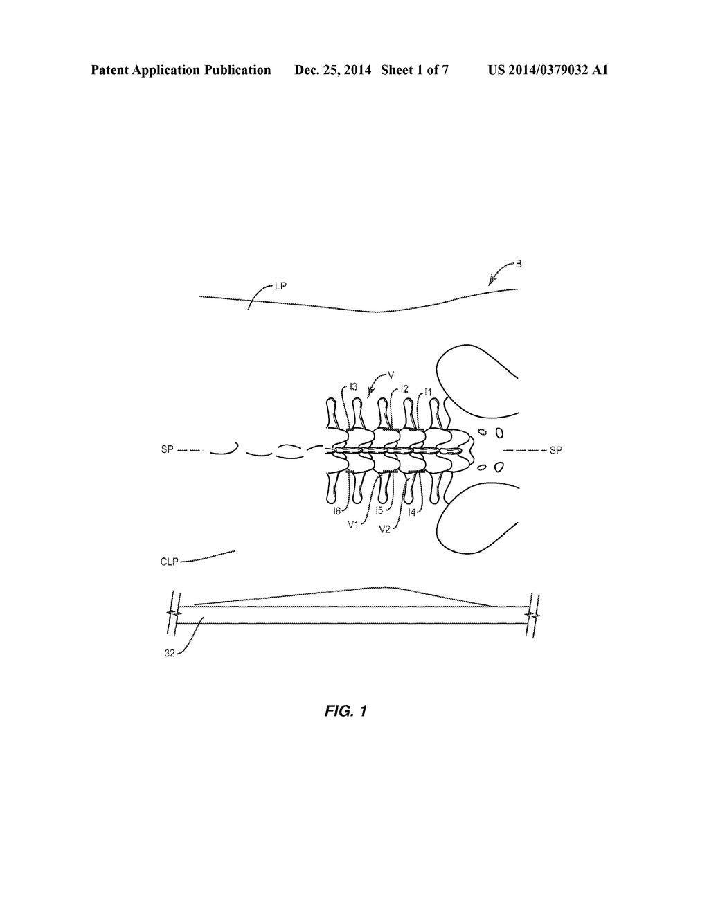 SPINAL IMPLANT SYSTEM AND METHOD - diagram, schematic, and image 02