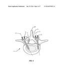 SPINAL IMPLANT SYSTEM AND METHOD diagram and image