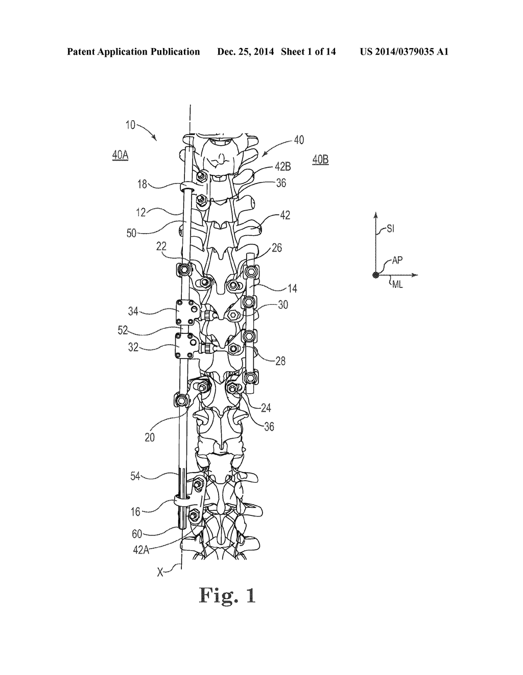 SPINAL CORRECTION AND SECONDARY STABILIZATION - diagram, schematic, and image 02