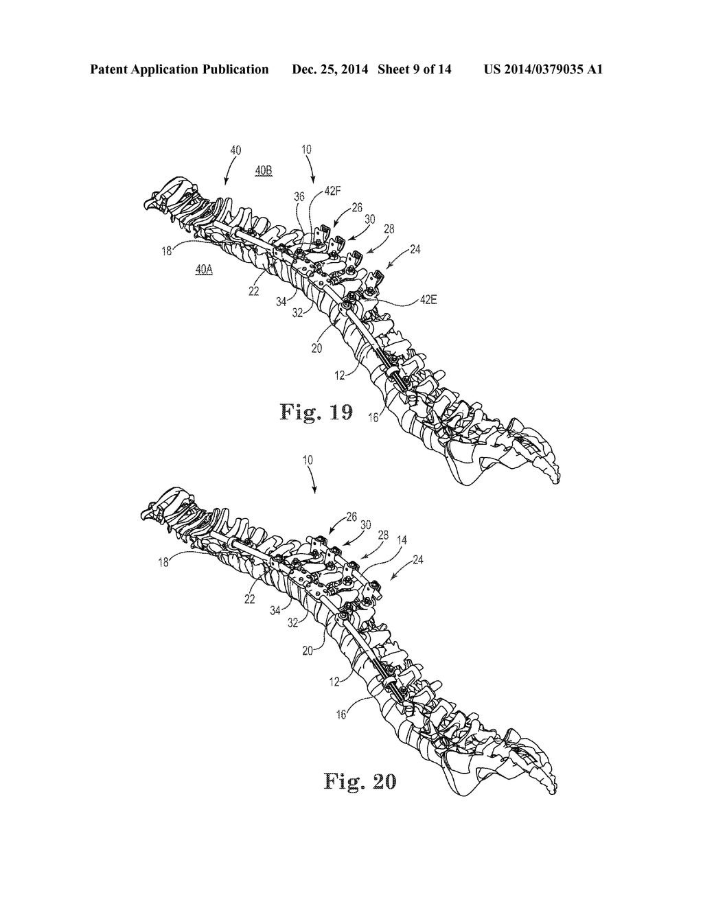 SPINAL CORRECTION AND SECONDARY STABILIZATION - diagram, schematic, and image 10