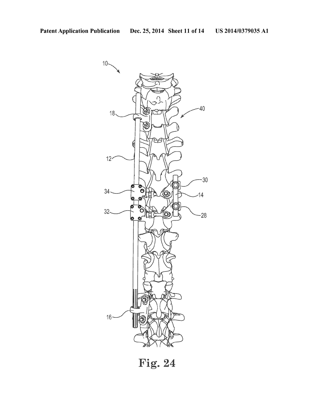 SPINAL CORRECTION AND SECONDARY STABILIZATION - diagram, schematic, and image 12