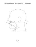 Treatment of Sleep Apnea via Bilateral Stimulation diagram and image