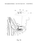 Treatment of Sleep Apnea via Bilateral Stimulation diagram and image