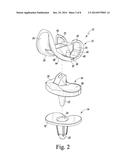 FEMORAL COMPONENT OF A KNEE PROSTHESIS HAVING AN ANGLED CEMENT POCKET diagram and image