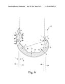 FEMORAL COMPONENT OF A KNEE PROSTHESIS HAVING AN ANGLED CEMENT POCKET diagram and image