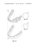 METHOD OF FORMING A DENTAL APPLIANCE diagram and image