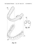 METHOD OF FORMING A DENTAL APPLIANCE diagram and image