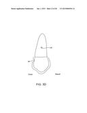 ORTHODONTIC REPOSITIONING APPLIANCES HAVING IMPROVED GEOMETRY, METHODS AND     SYSTEMS diagram and image