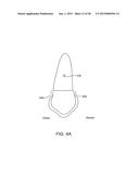 ORTHODONTIC REPOSITIONING APPLIANCES HAVING IMPROVED GEOMETRY, METHODS AND     SYSTEMS diagram and image