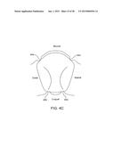 ORTHODONTIC REPOSITIONING APPLIANCES HAVING IMPROVED GEOMETRY, METHODS AND     SYSTEMS diagram and image
