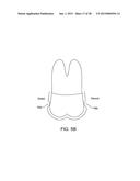 ORTHODONTIC REPOSITIONING APPLIANCES HAVING IMPROVED GEOMETRY, METHODS AND     SYSTEMS diagram and image