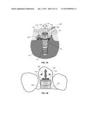 DENTAL RENTENTION SYSTEMS diagram and image