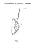 INTRAOCULAR SHUNT IMPLANTATION diagram and image