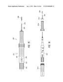 INTRAOCULAR SHUNT IMPLANTATION diagram and image