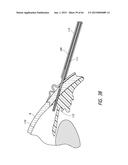 INTRAOCULAR SHUNT IMPLANTATION diagram and image